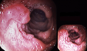 Bowel Cancer: The Pathway to Breakdown and the Road Back to Bioharmony